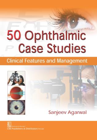 Book cover number 1 for 50 Ophthalmic Case Studies : Clinical Features And Management written by Sanjeev Agarwal published by CBS Publishers & Distributors Pvt. Ltd.